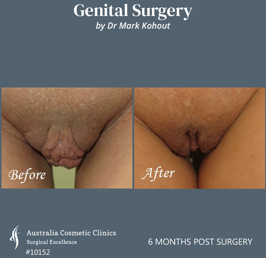 Labiaplasty Patient 10152 Front