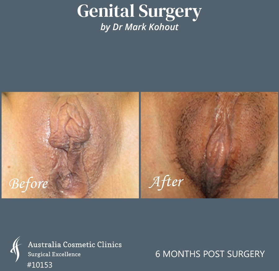 Labiaplasty Patient 10153 Front