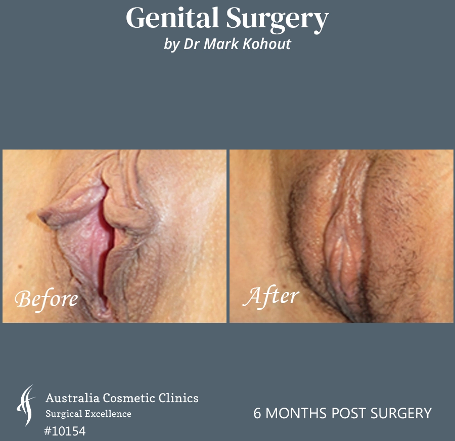 Labiaplasty Patient 10154 Front