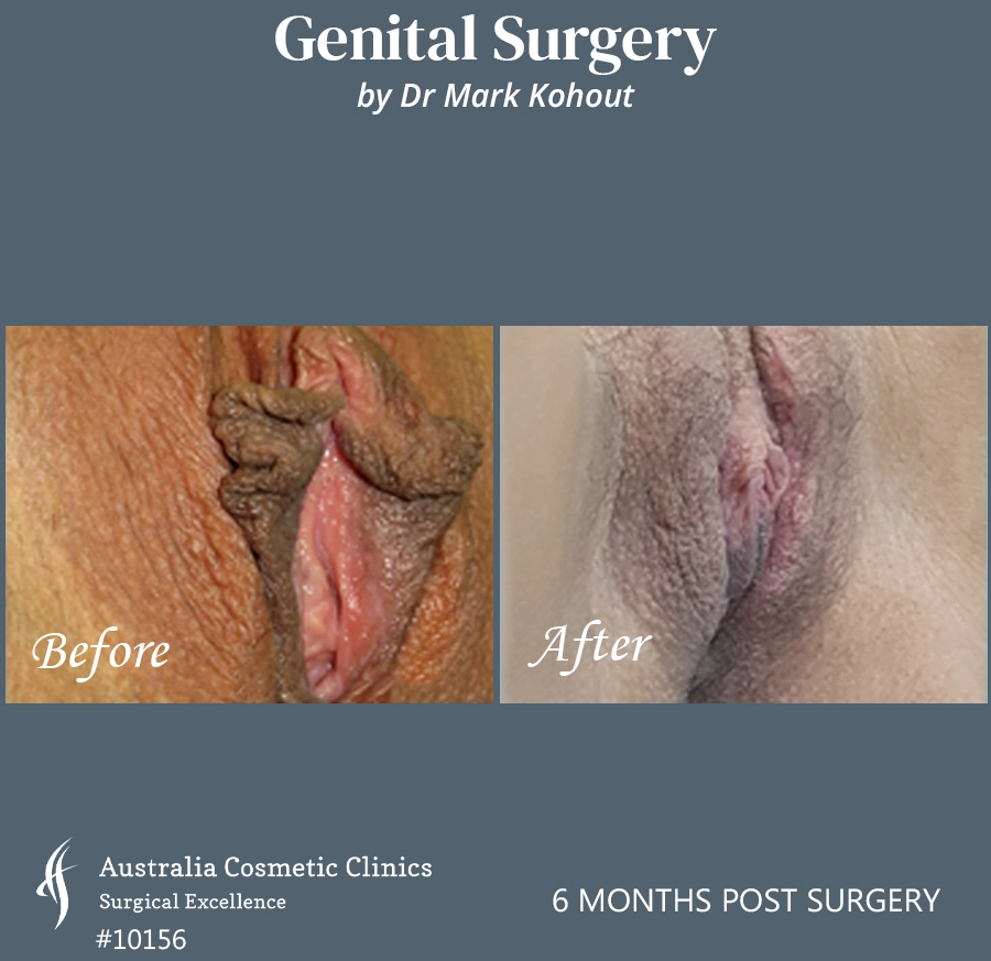 Labiaplasty Patient 10156 45
