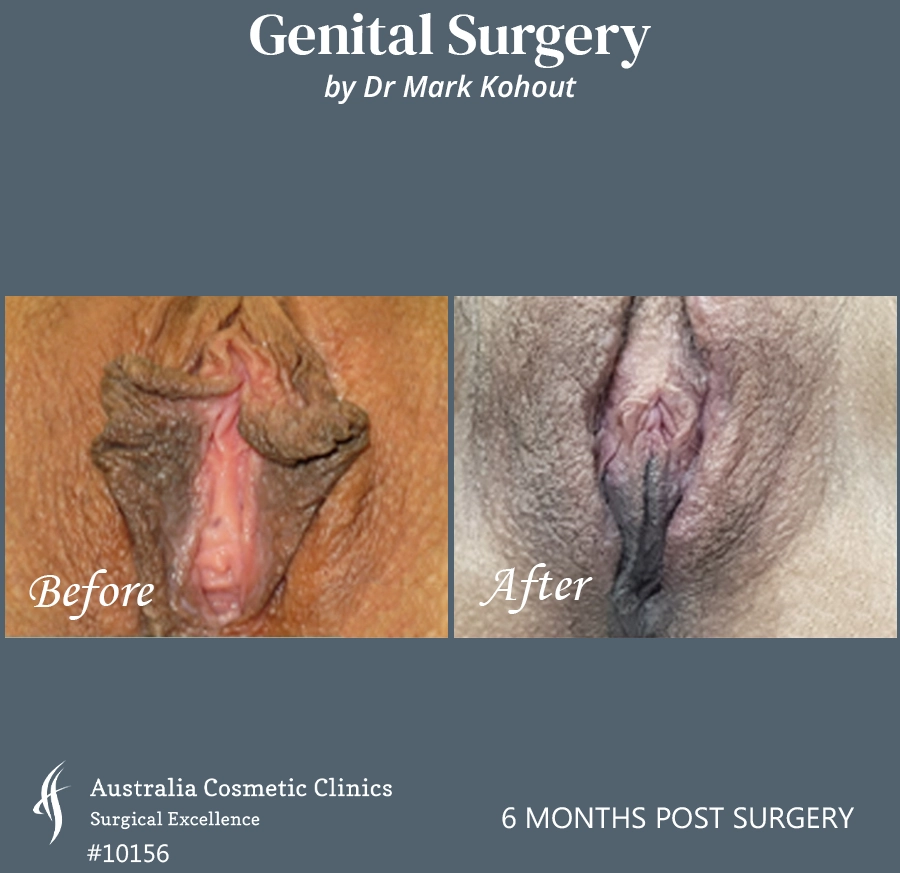 Labiaplasty Patient 10156 Front