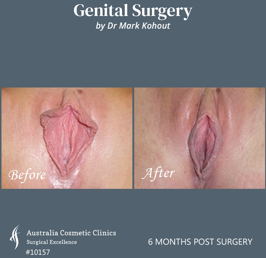 Labiaplasty Patient 10157 Front