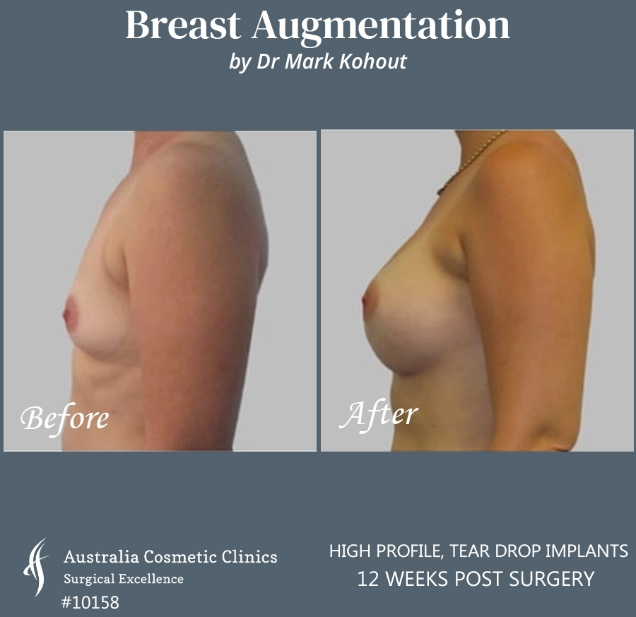 Tear Drop Implants Patient 10158 Side