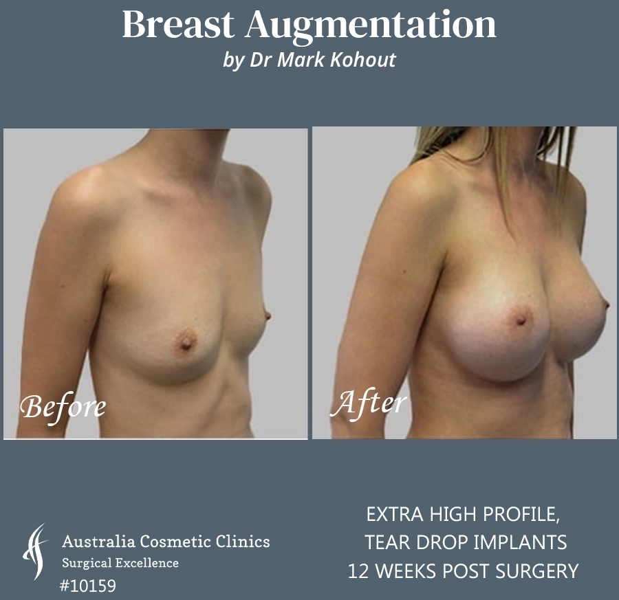 Tear Drop Implants Patient 10159 45