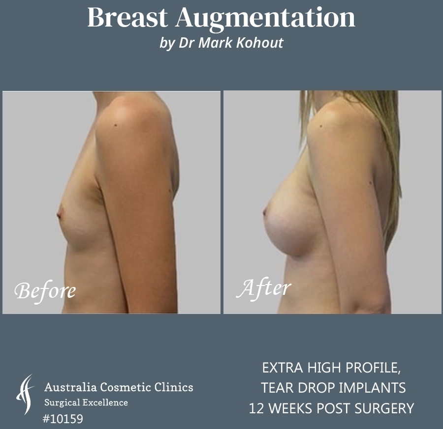 Tear Drop Implants Patient 10159 Side