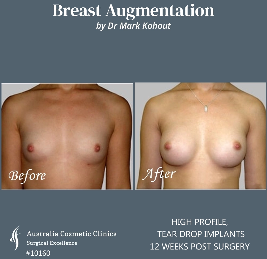 Tear Drop Implants Patient 10160 Front
