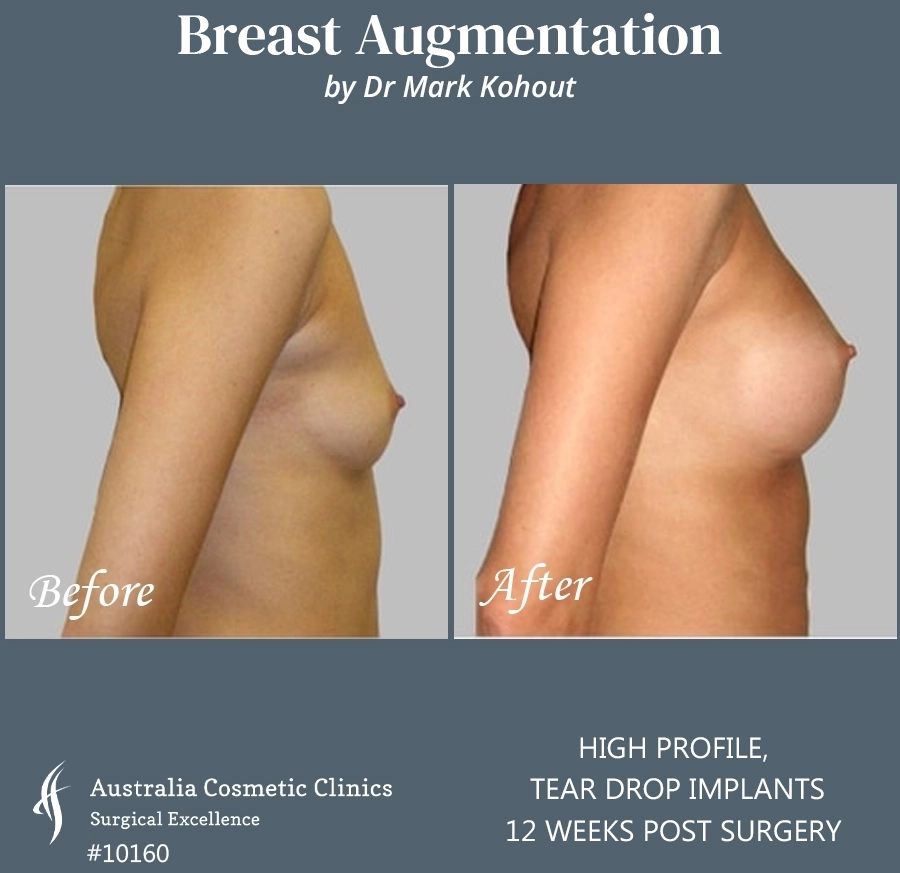 Tear Drop Implants Patient 10160 Side