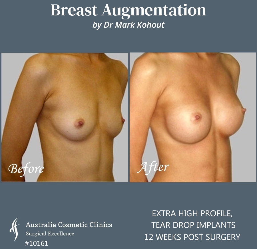 Tear Drop Implants Patient 10161 45