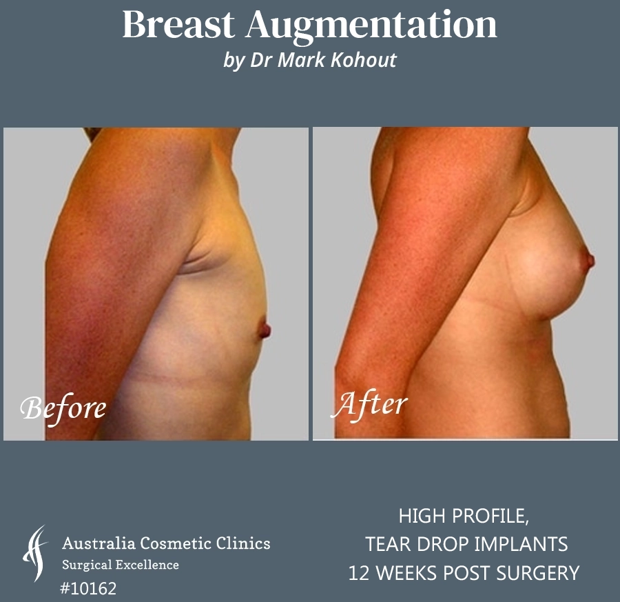 Tear Drop Implants Patient 10162 Side