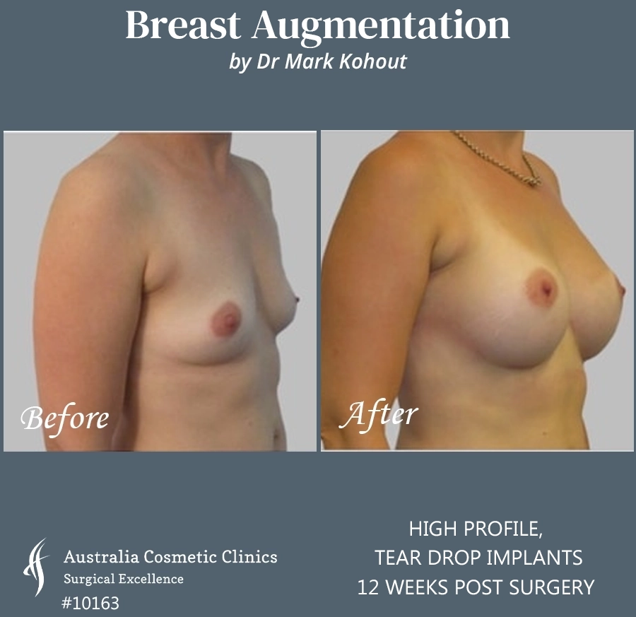 Tear Drop Implants Patient 10163 45