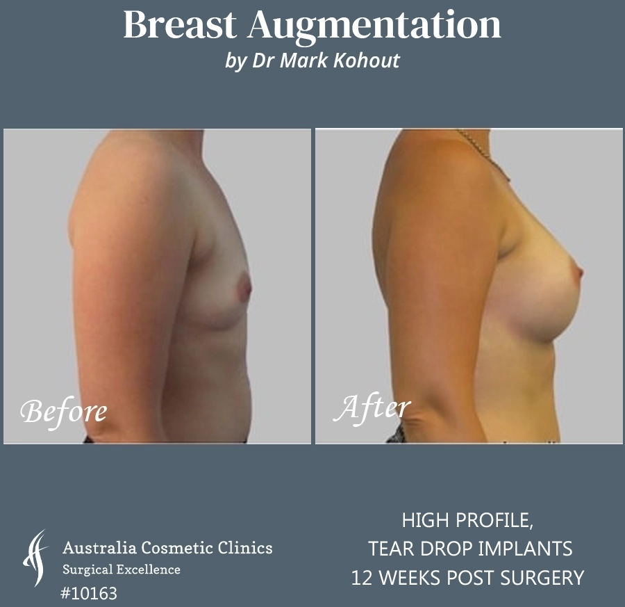 Tear Drop Implants Patient 10163 Side