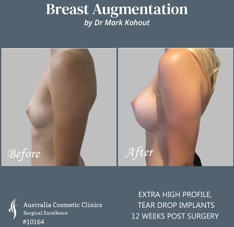 Tear Drop Implants Patient 10164 Side