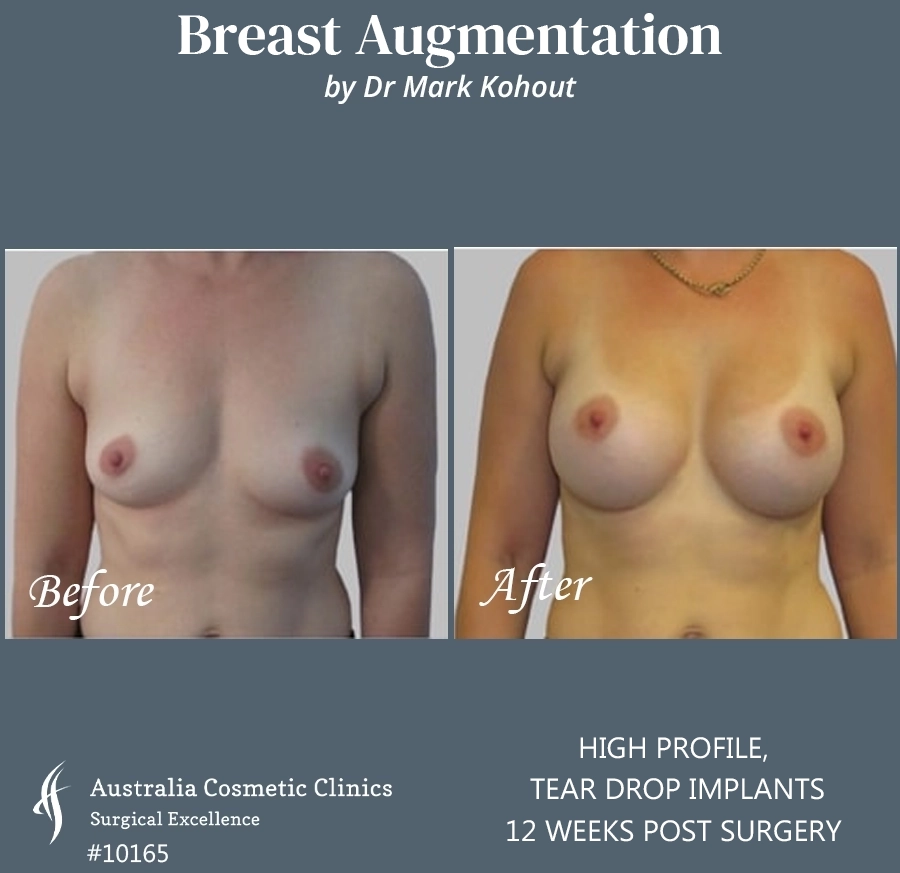 Tear Drop Implants Patient 10165 Front