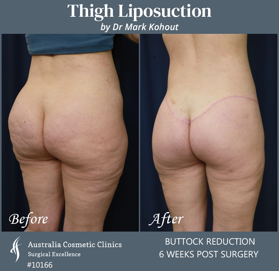 Thigh Liposuction Patient 10066 BACK 45