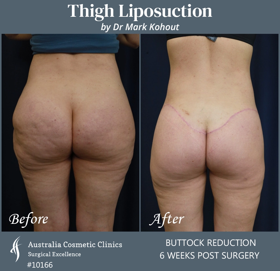 Thigh Liposuction Patient 10066 BACK