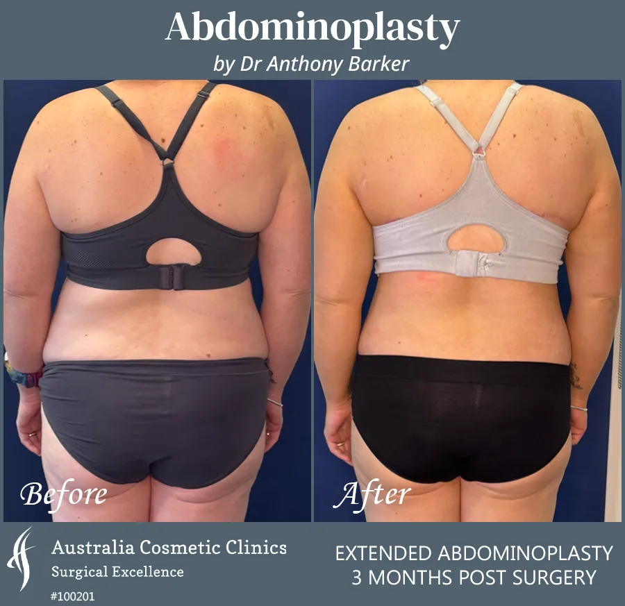 Abdominoplasty Patient 100201 Back