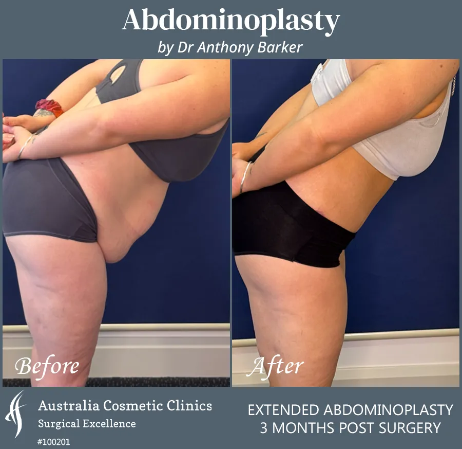 Abdominoplasty Patient 100201 Left Bend Over