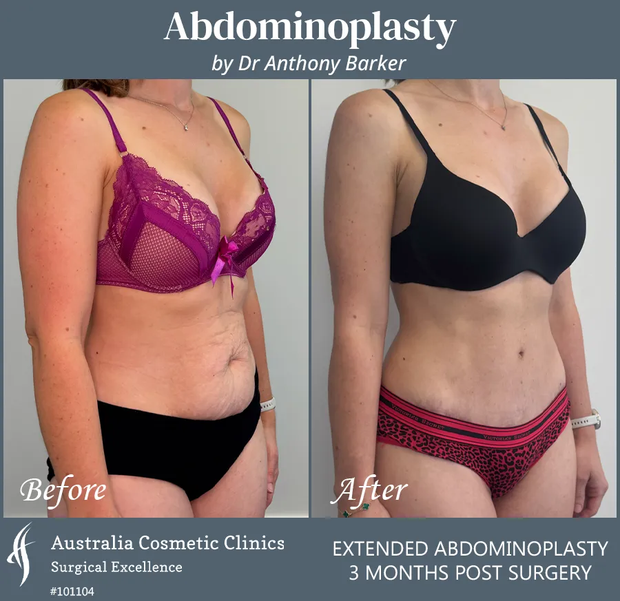 Abdominoplasty Patient 101104 45