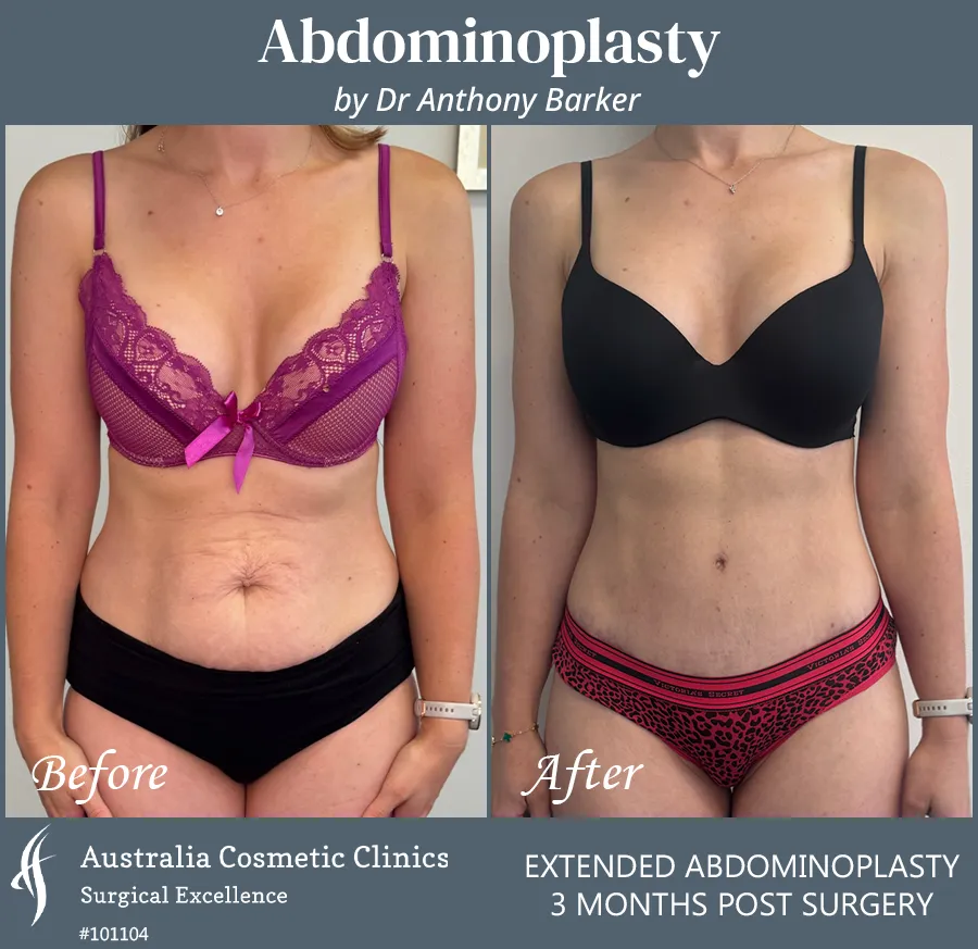 Abdominoplasty Patient 101104 Front