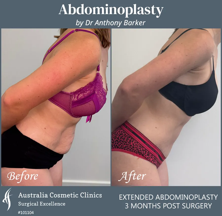 Abdominoplasty Patient 101104 Left Bend Over
