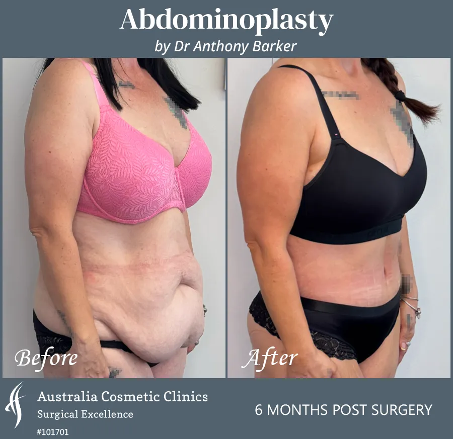 Abdominoplasty Patient 101701 45