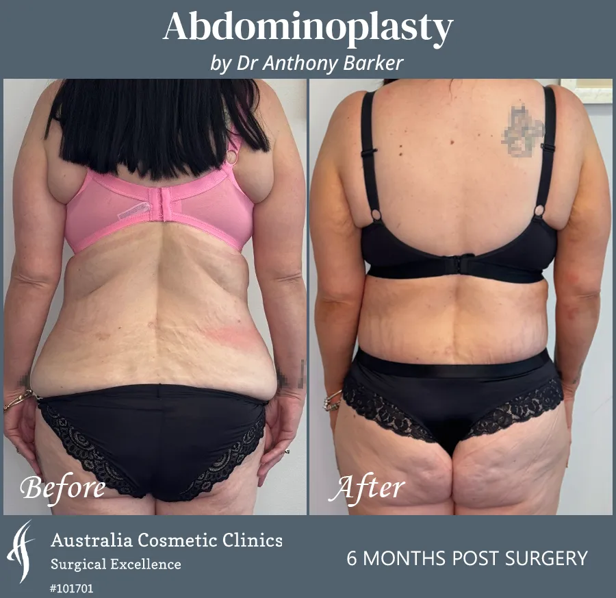 Abdominoplasty Patient 101701 Back