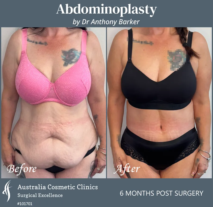 Abdominoplasty Patient 101701 Front