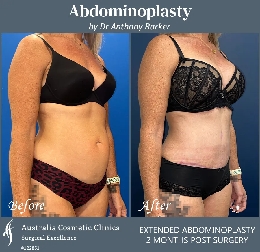 Abdominoplasty Patient 122851 45