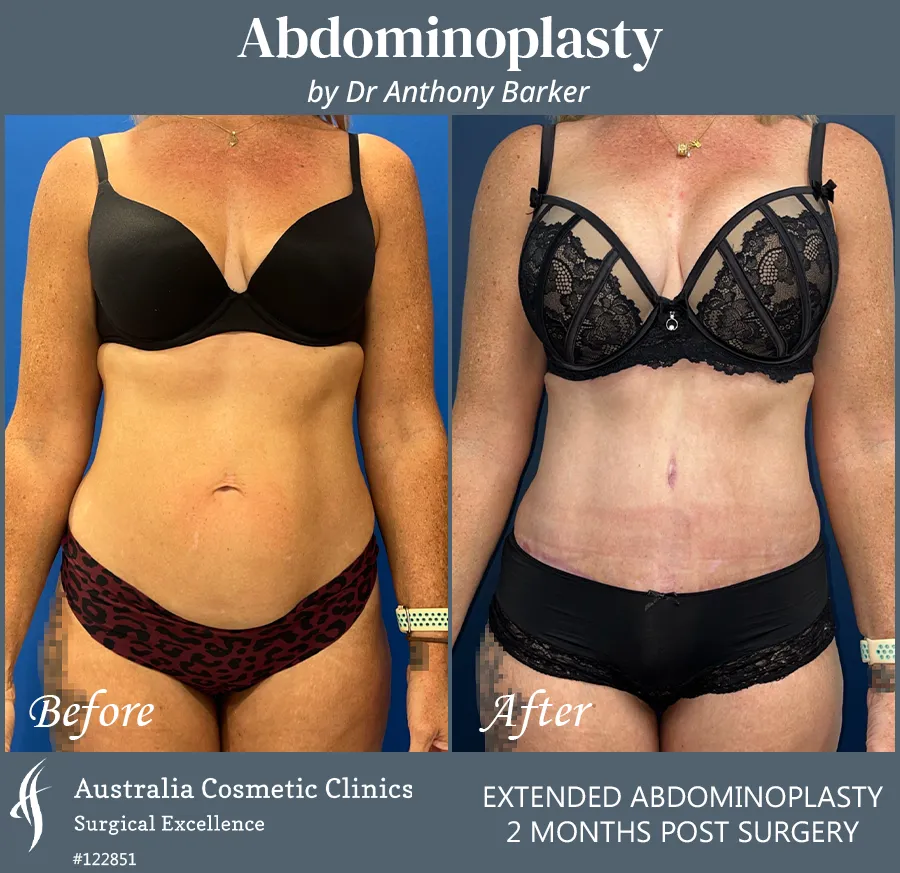 Abdominoplasty Patient 122851 Front