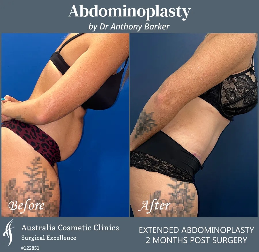 Abdominoplasty Patient 122851 Left Bend Over