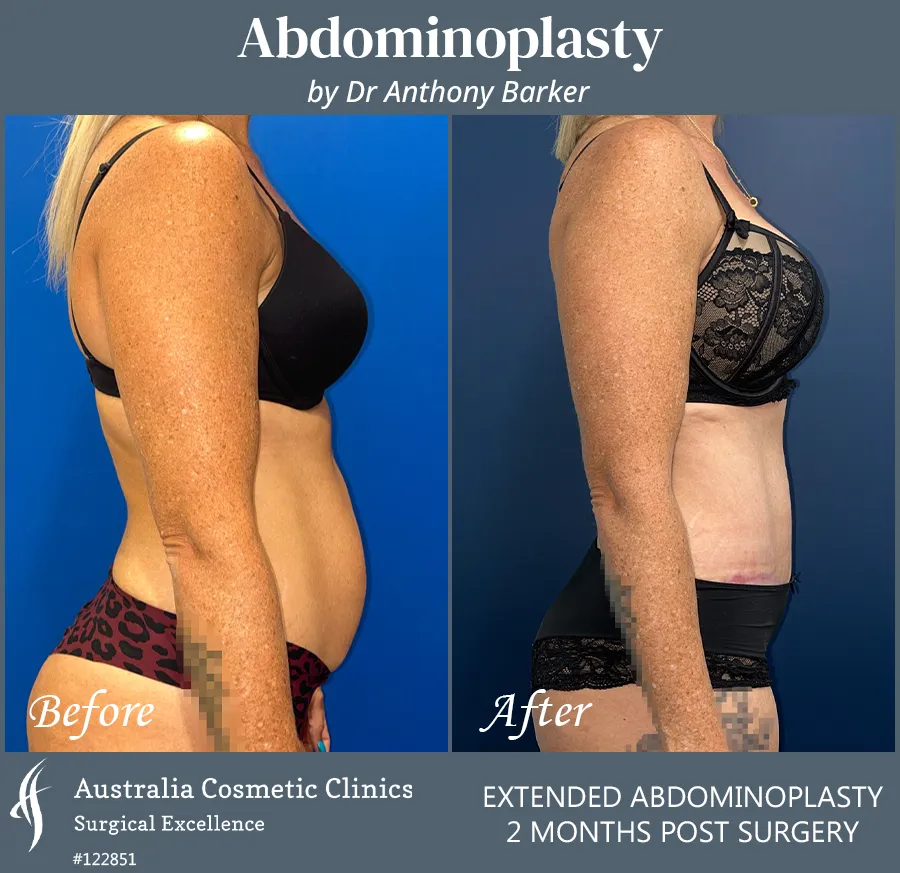 Abdominoplasty Patient 122851 Side