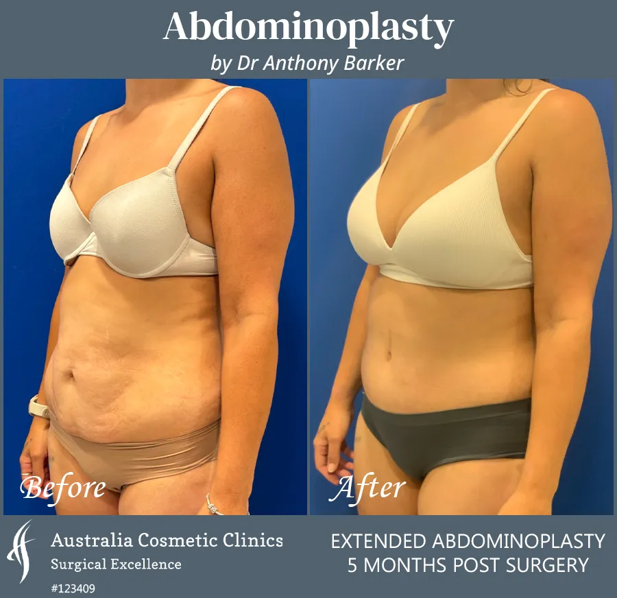 Abdominoplasty Patient 123409 45