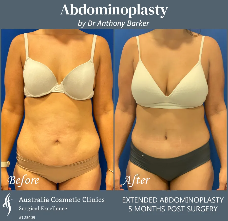 Abdominoplasty Patient 123409 Front