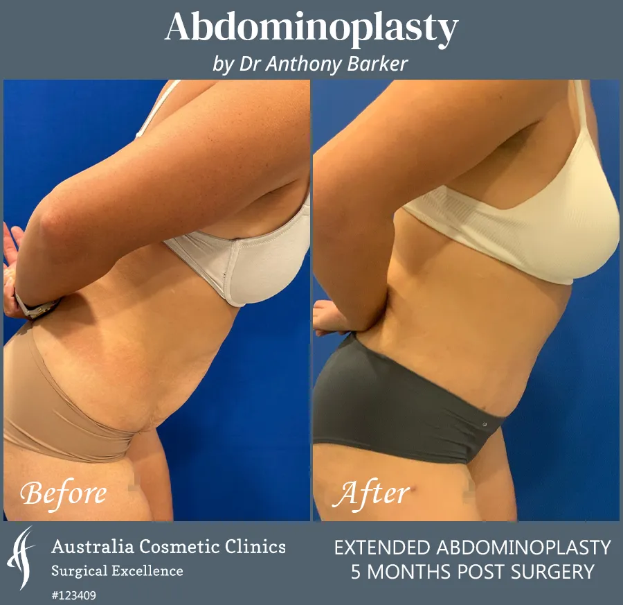 Abdominoplasty Patient 123409 Left Bend Over