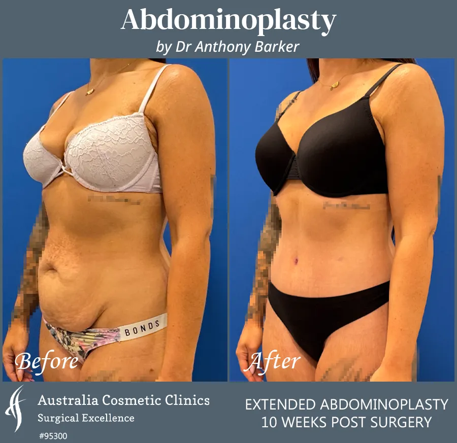 Abdominoplasty Patient 95300 45