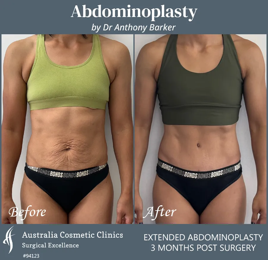 Abdominoplasty Patient 95300 Front