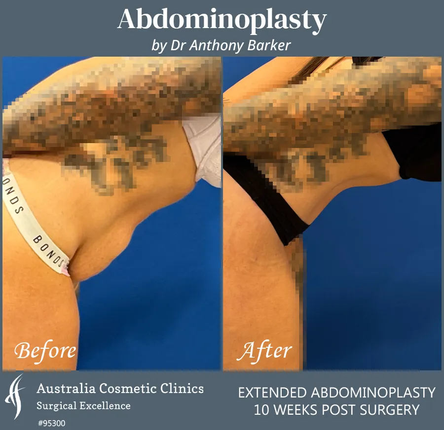 Abdominoplasty Patient 95300 Left Bend Over