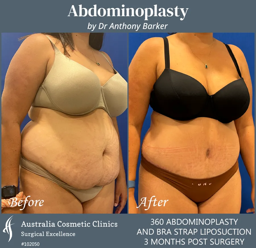 Abdominoplasty and Bra Strap Liposuction Patient 102050 45