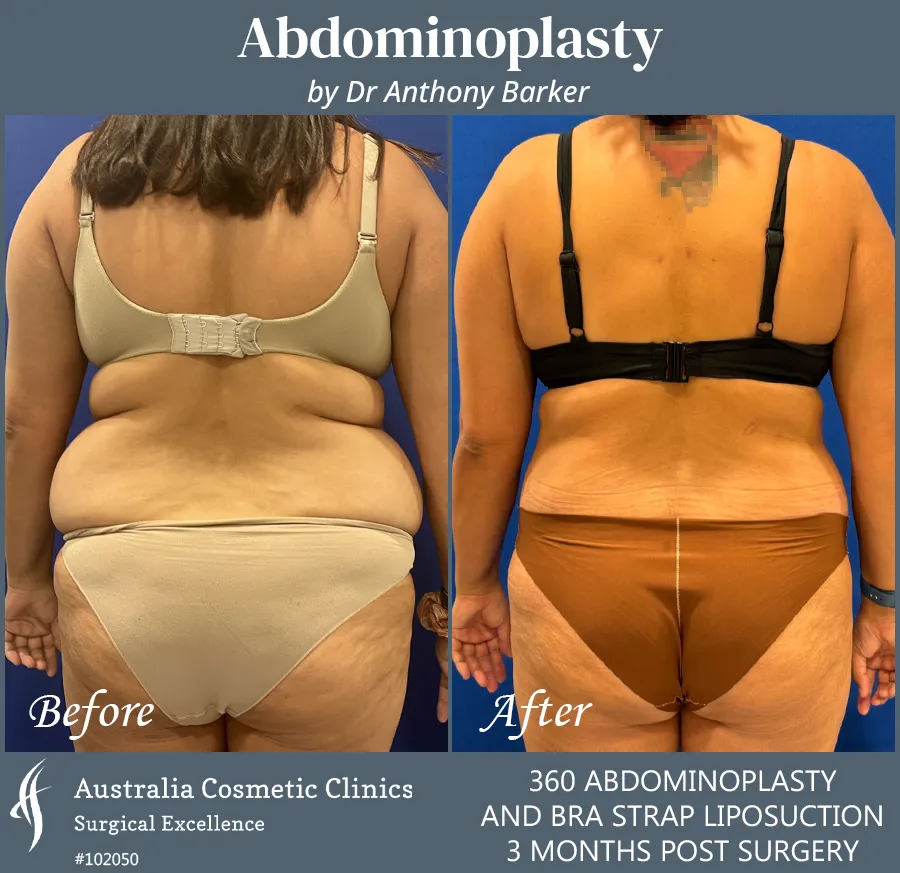 Abdominoplasty and Bra Strap Liposuction Patient 102050 Back