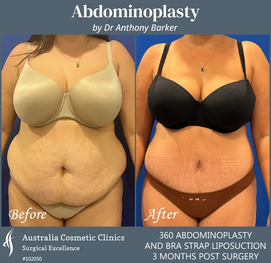 Abdominoplasty and Bra Strap Liposuction Patient 102050 Front