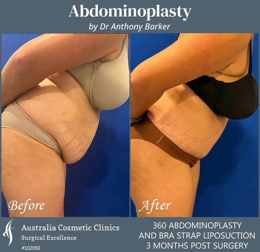 Abdominoplasty and Bra Strap Liposuction Patient 102050 Left Bend over