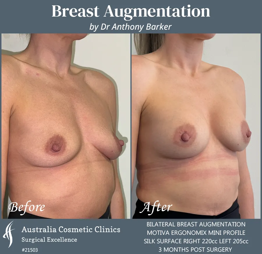 Breast Augmentation Patient 21503 45