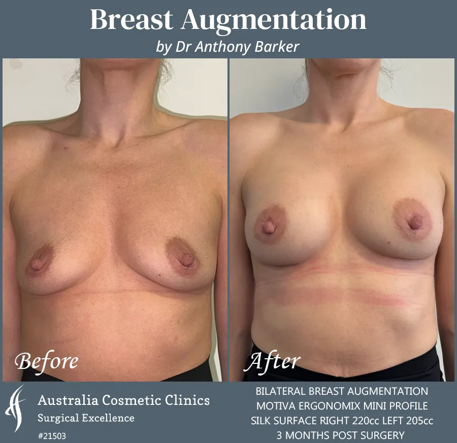 Breast Augmentation Patient 21503 Front