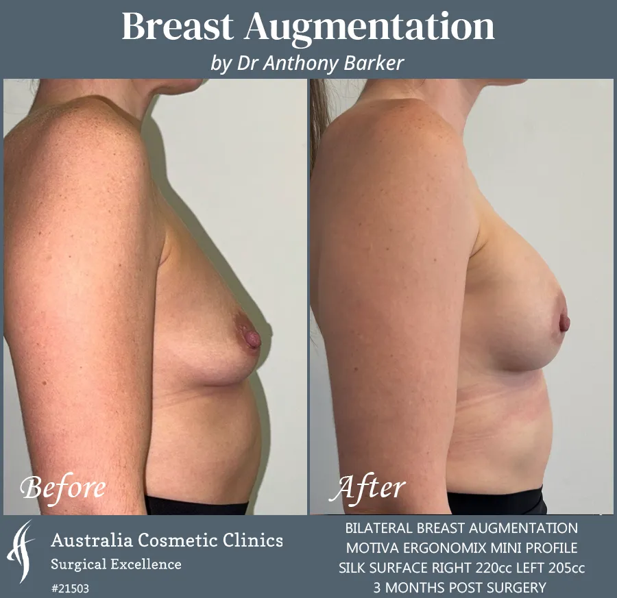 Breast Augmentation Patient 21503 Side