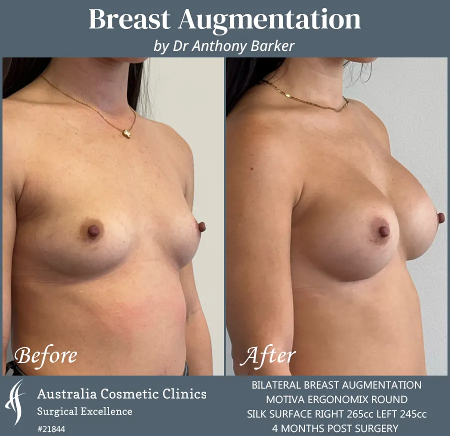 Breast Augmentation Patient 21844 45