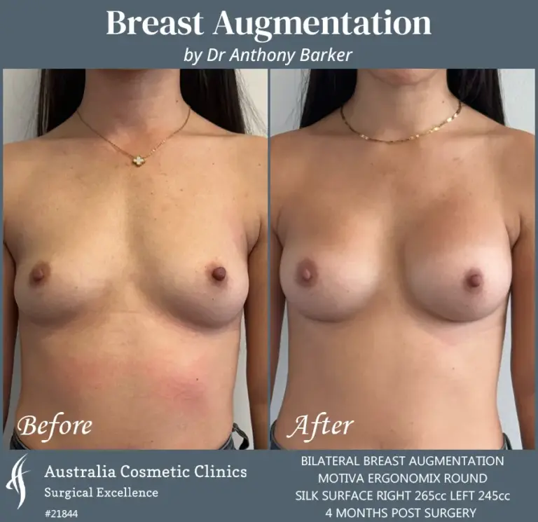 Breast Augmentation Patient 21844 Front