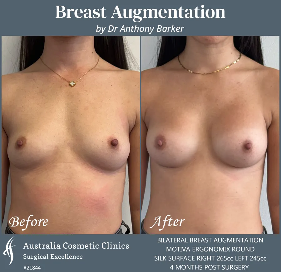 Breast Augmentation Patient 21844 Front