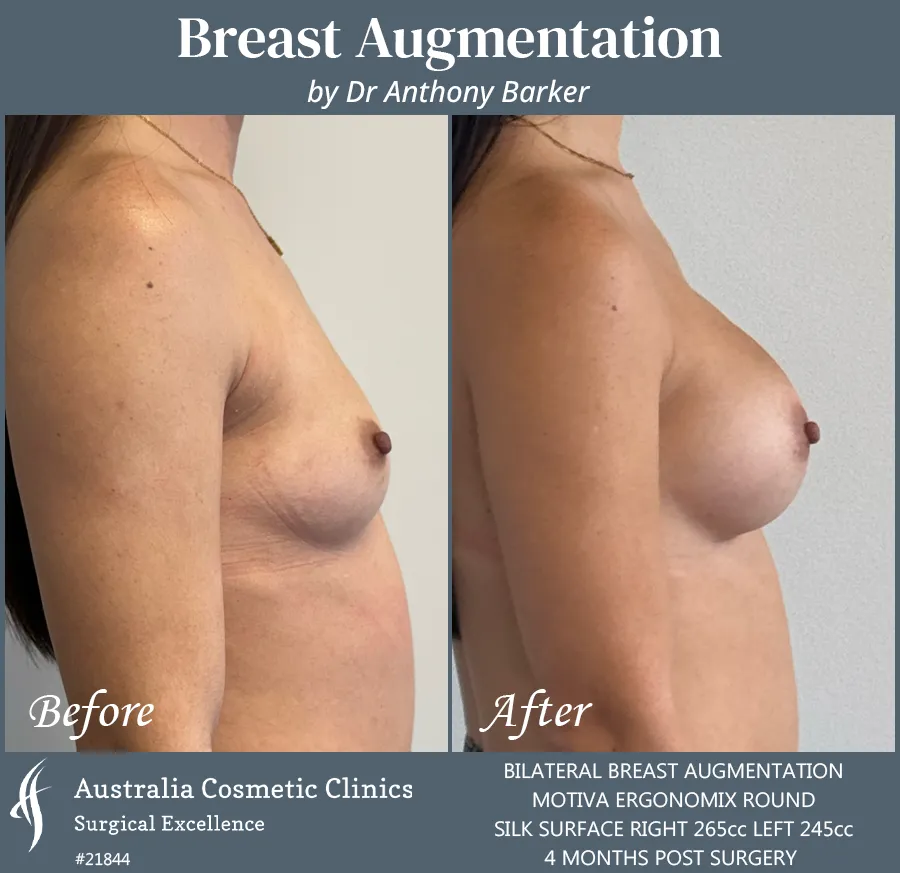 Breast Augmentation Patient 21844 Side