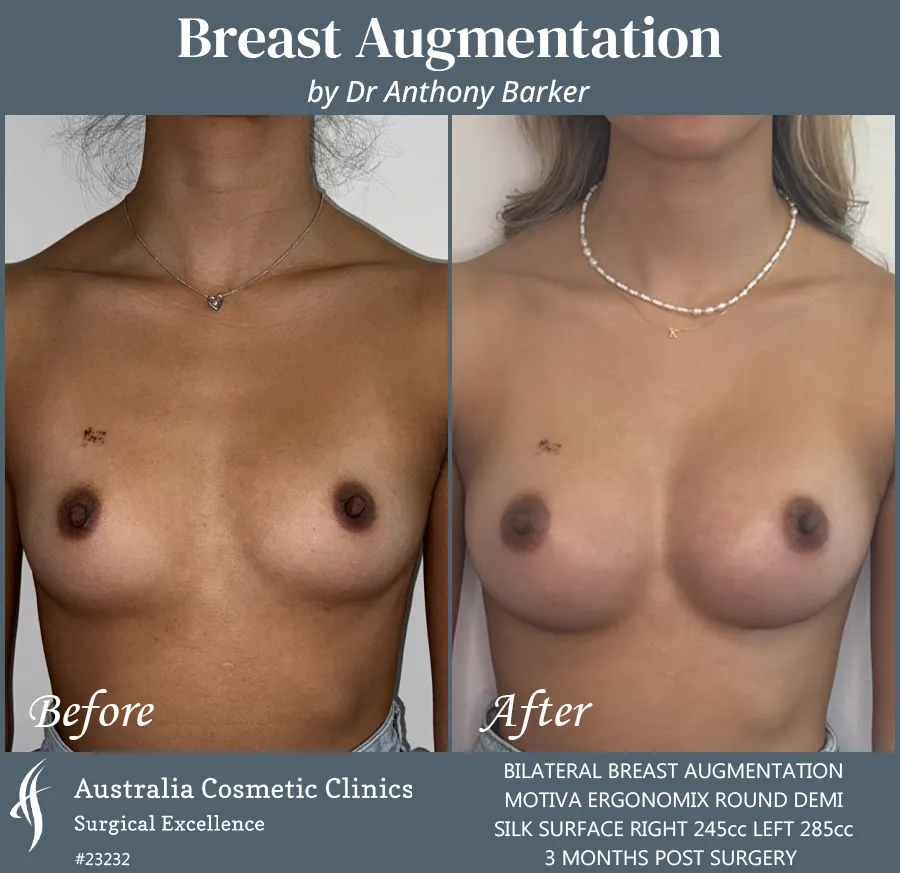 Breast Augmentation Patient 23232 Front