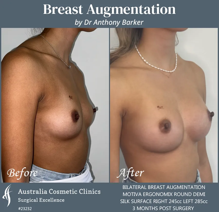 Breast Augmentation Patient 23232 Left 45